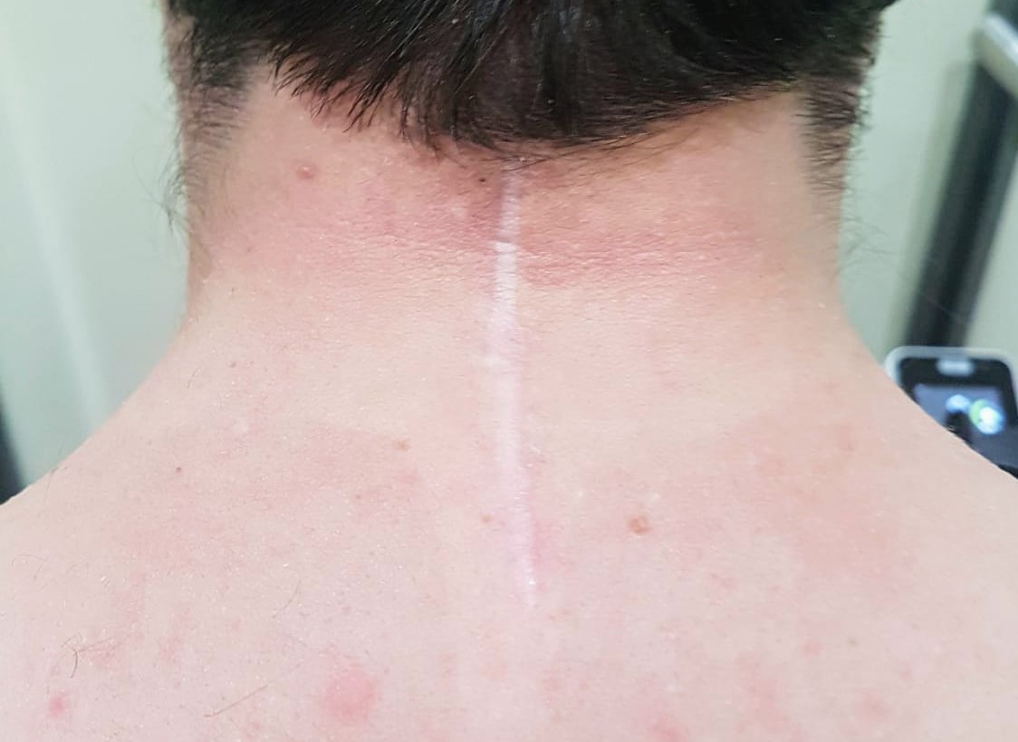 neck scar (1)